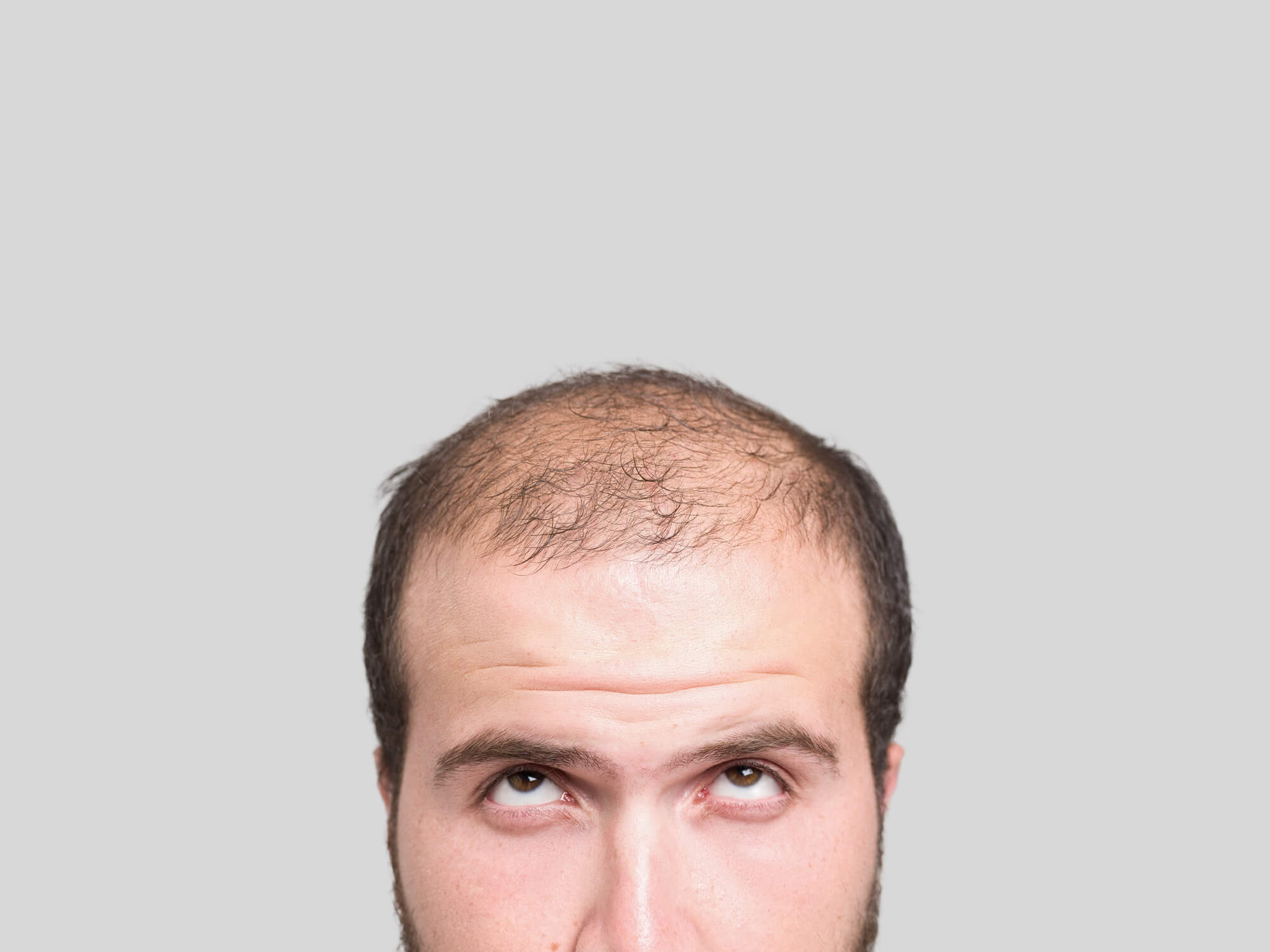 Tratamento Calvície Masculina