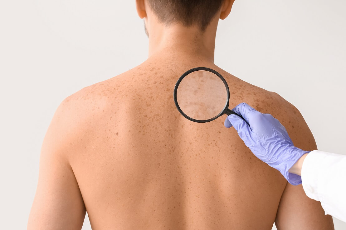Tratamento Manchas / Melasma