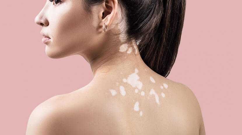 foto de Vitiligo