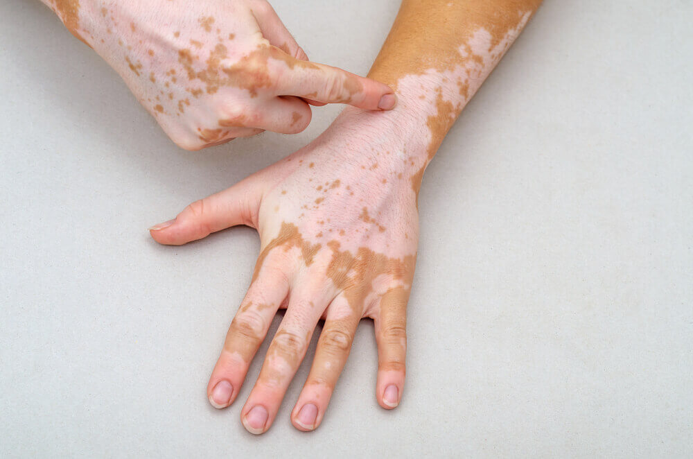 Tratamento Vitiligo