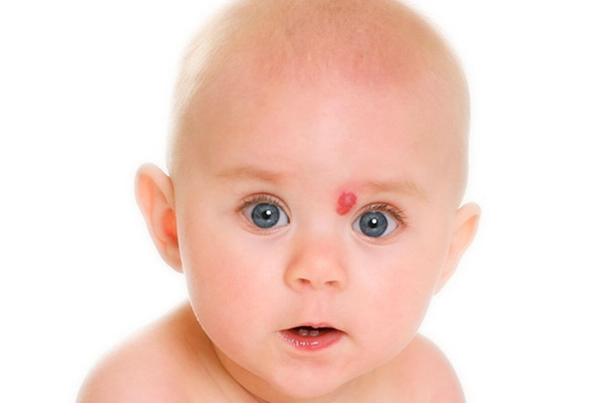 foto de Hemangioma